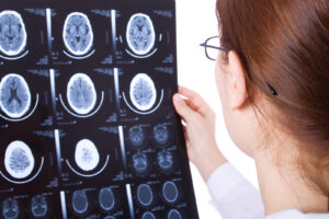 Los Angeles Catastrophic Injury Attorney